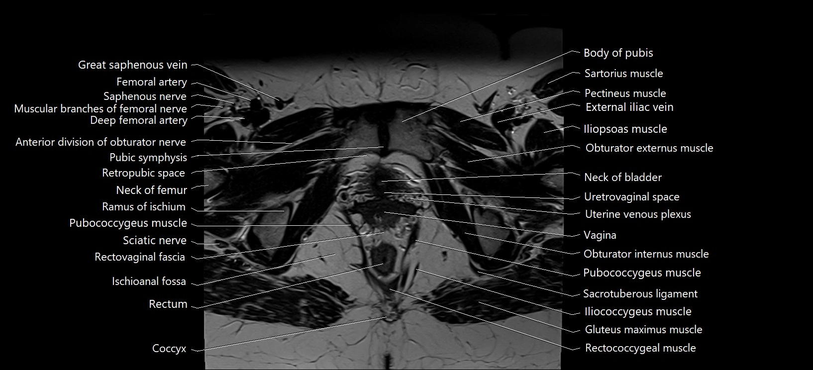 Axial cross sectional anatomy of female pelvis (MRI 3T) image 34.webp
